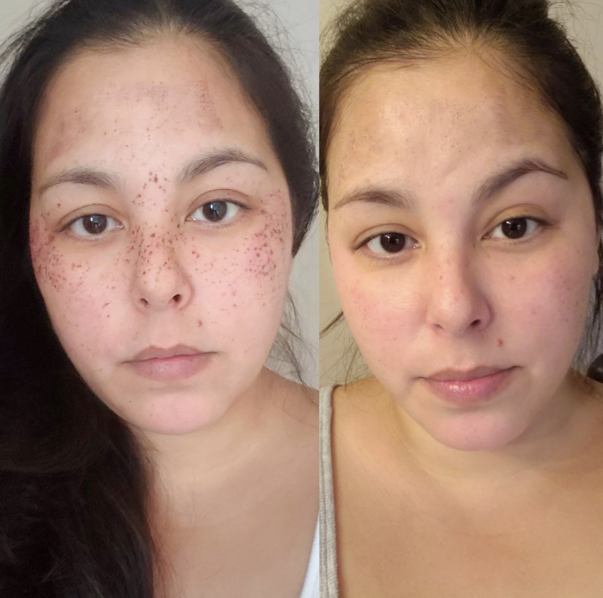 Ipl foto facial